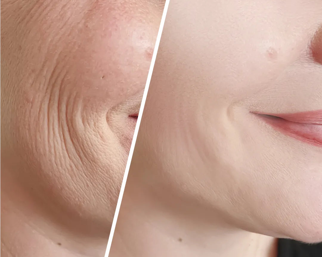 Hvorfor opstår rynker under øjnene